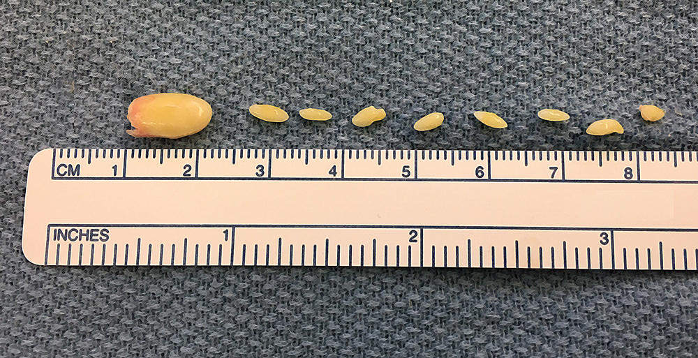 Image of a salivary stone two centimeters in size and a series of smaller stones.